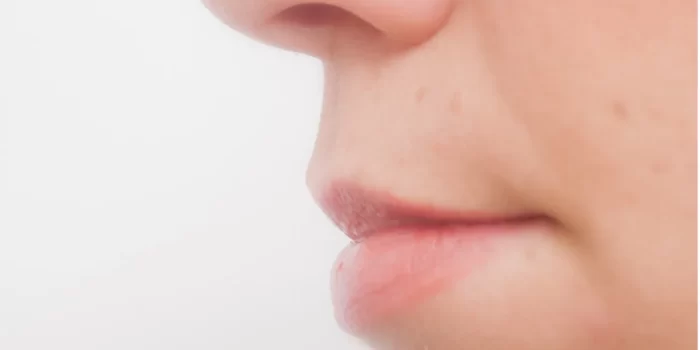 overbite-dentition02